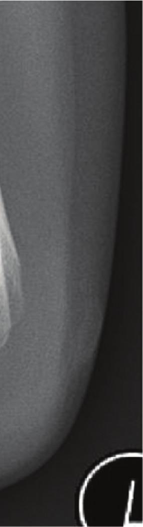 Medial or antero-medial dislocation of the radial head with fracture of the proximal ulna. Monteggia.