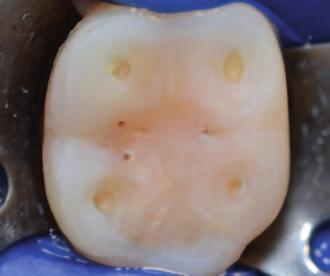functionl occlusl reltionship Direct nd indirect dhesive restortions, prosthodontics. without or with incresing verticl dimension. Totl orl rehilittion of two rches in 2 stges: 1.