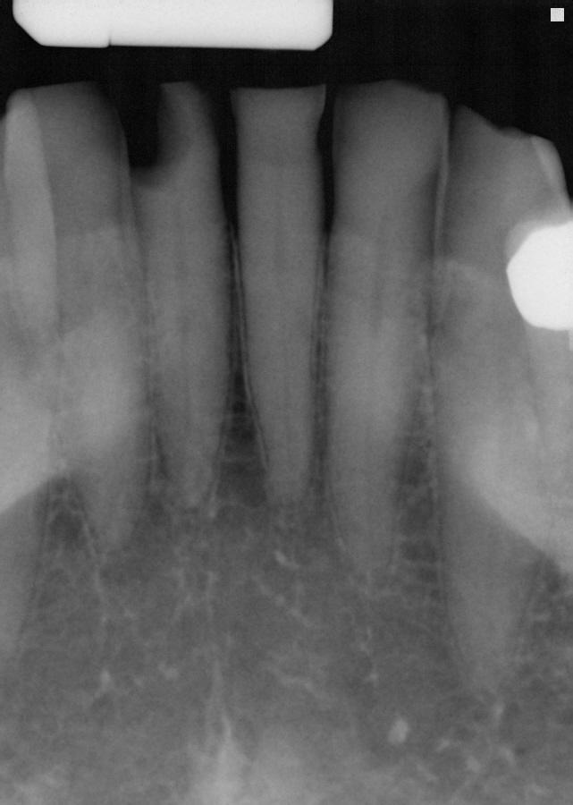 Figures 1 and 1. Radiograph of distal D3 approximal lesion on tooth # 41 case, the healthcare provider has limited options: 1. no SDF placement at all (do nothing), 2.