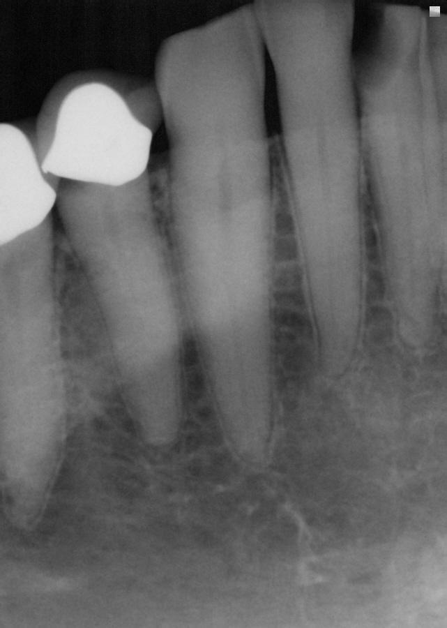 place SDF and a glass ionomer cement (GIC) sealant/restoration during the same appointment to limit access of fermentable carbohydrates and improve chances of SDF caries arrest.