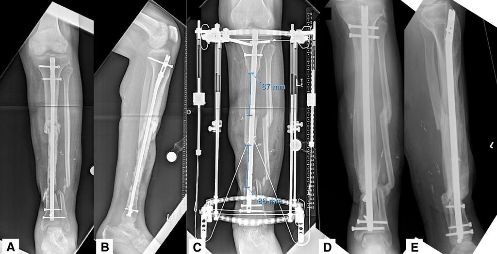Integrated Fixation for Tibial Bone Defects Fig. 1A E (A) AP and (B) lateral radiographs show a 31-year-old man who presented with a 17.