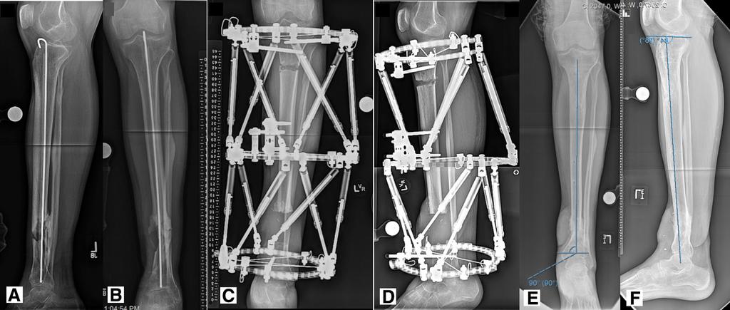 Final radiographs (D E) demonstrate maintenance of alignment, docking site union, and no infection 1 year after reconstruction. Fig.