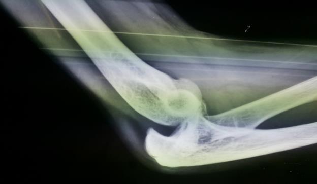 The fracture may also be associated with a posterior dislocation of the elbow (6). Many authors have disputed controversies regarding radial neck fractures management (7).
