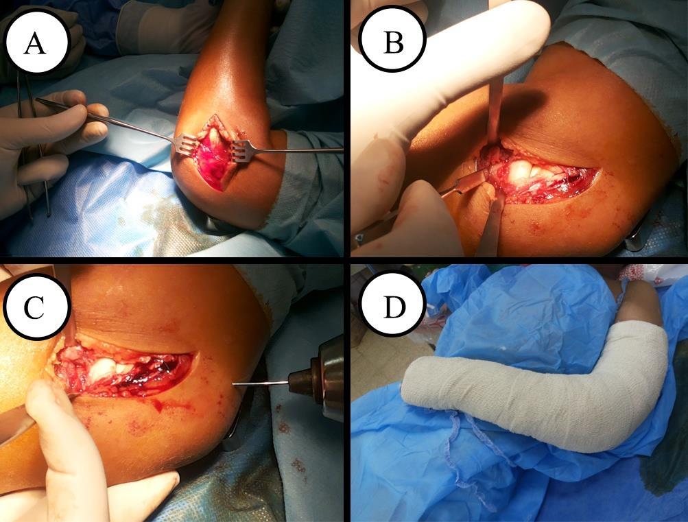 made the reduction of the fracture easier. Reduction was performed by applying traction while the forearm supinated with repositioning of the radial head to its anatomical site.