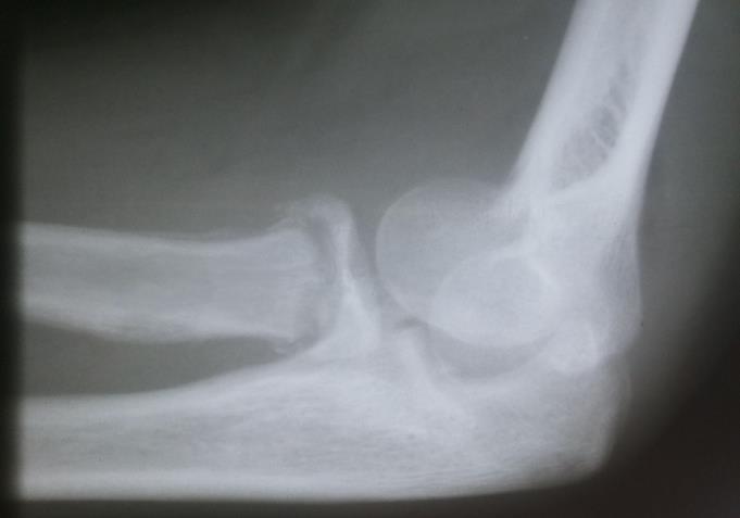 stiffness and valgus deformity, two other complications occurred; in which two patients had implant failure (figure 6) and one other patient developed neuropraxia of the posterior interosseous nerve.