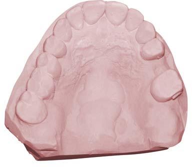 CT Scan Appliance Step 1 Prepare dental stone model from