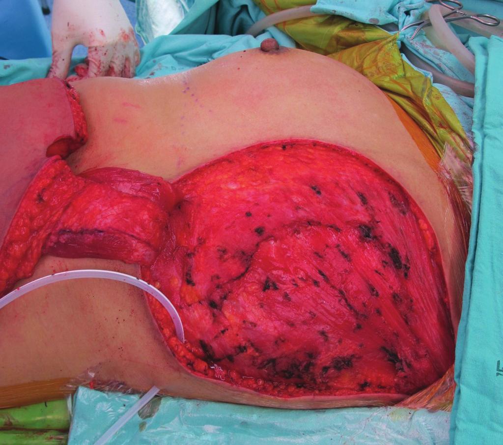 39-year-old woman presented with a large mass in the left breast.