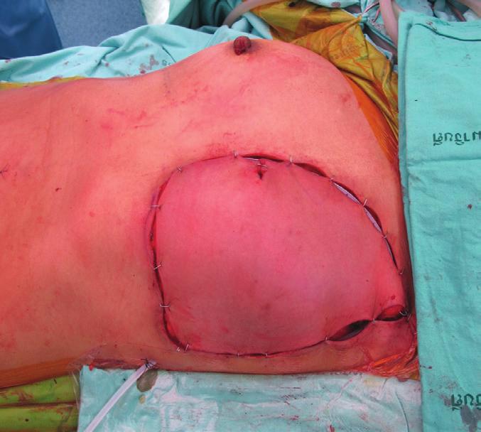 () Preoperative presentation with bulging mass apparent on inspection; ()