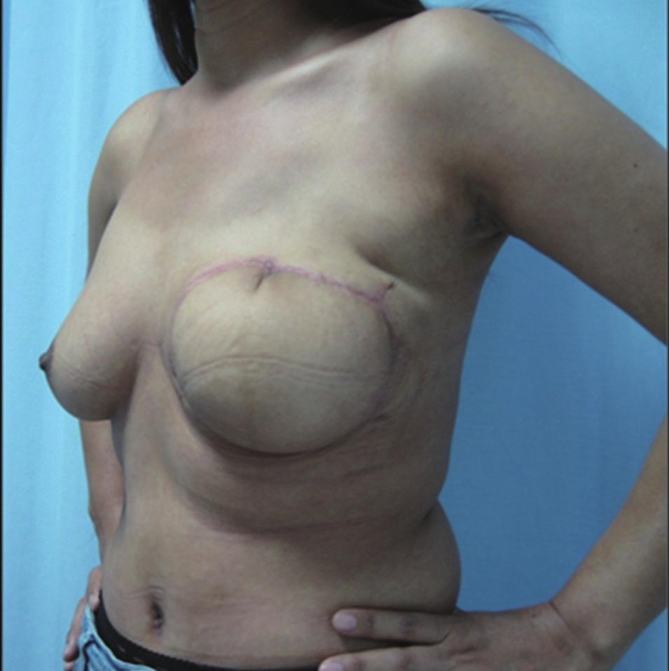 intraoperative view after simple mastectomy with 3 cm lateral margins of