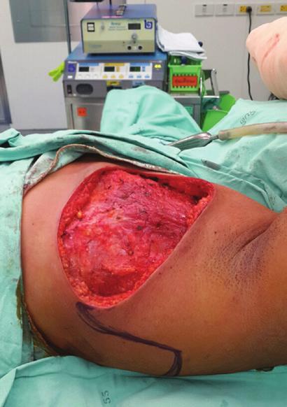 The large tumor was partially responsiveness to systemic treatment. The patient requested tumor removal because of pain.