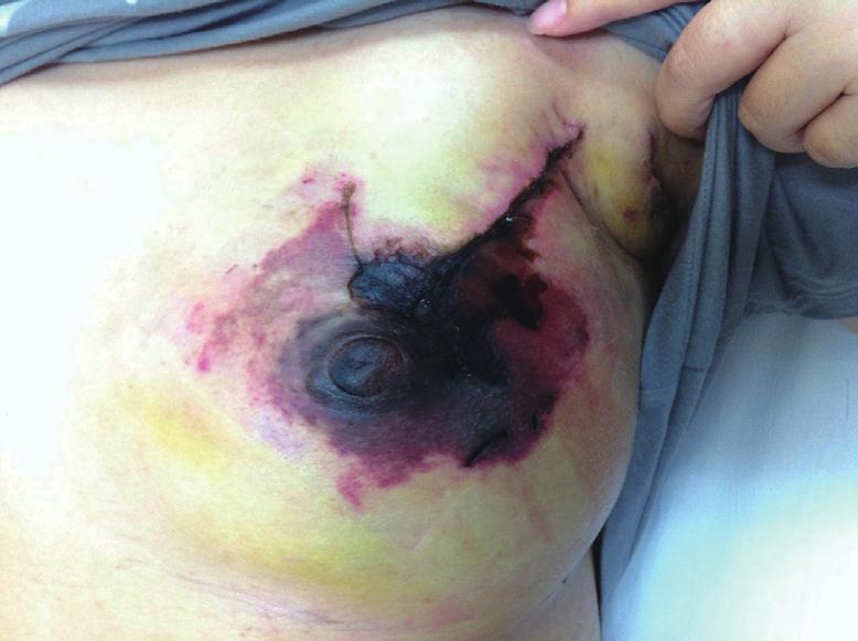 Gland Surgery, Vol 5, No 1 February 2016 81 C D Figure 8 Presentation and management of a mastectomy skin flap necrosis occurred after performing NSM with LD flap plus implant reconstruction.