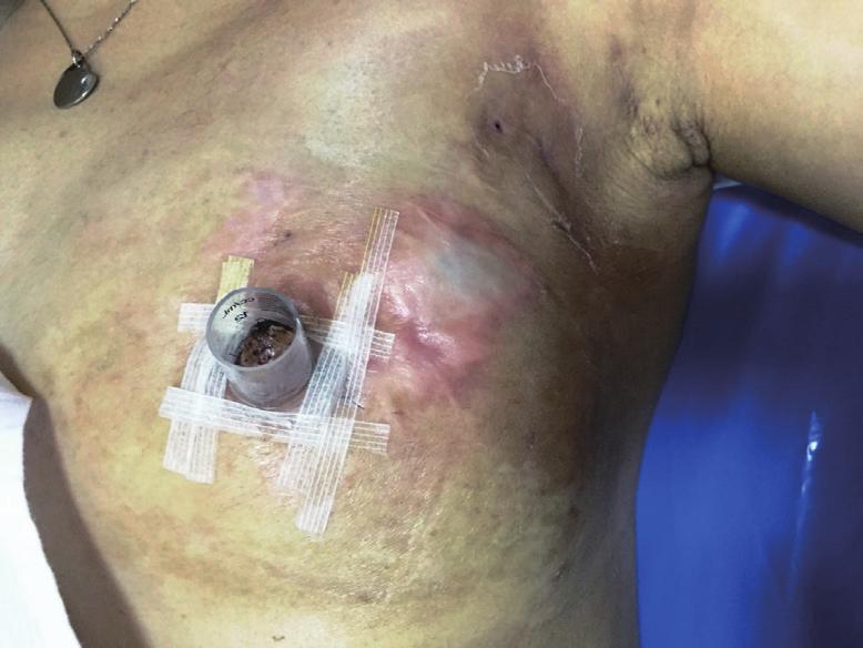 Salvage mastectomy and reconstruction for stage IV breast cancer is a feasible procedure, providing adequate local disease control and excellent palliation of very disabling symptoms in selected