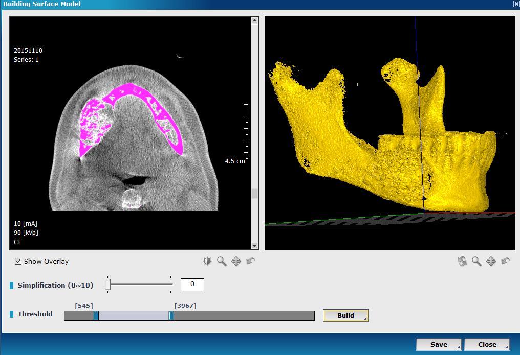 . The pre-surgical CBCT, obtained within the OMFS clinic, was utilized to generate and export a STL file to allow a 1:1 bio-model to be printed in the clinical setting.