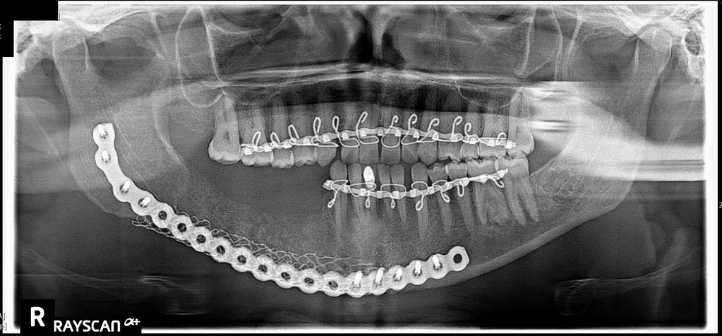 The patient was maintained in maxillo-mandibular fixation for six weeks.