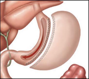 Sleeve Gastrectomy Newer procedure created for a two-step procedure Restrictive effect from the stomach Removes ~80-85% of the stomach NONreversible NO malabsorption Big