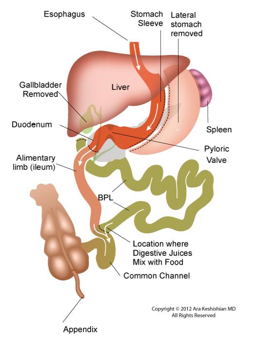 Duodenal Switch (BPD/DS) Much more malabsorptive than RyGB/ SIPS Typically for severely obese (BMI >50) 75% stomach removed; 75% of GI tract bypassed Common channel: 50-150 cm (essentially short gut)