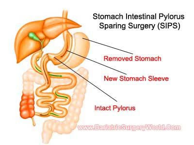 SIPS (Stomach Intestinal Pylorus Sparing Surgery) Newer procedure to create more malabsorption!