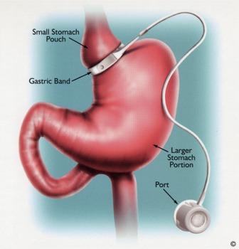 LAGB (Laparoscopic Adjustable Gastric Band) Restricts amount of food upper stomach can hold (~1/2 cup) Normal absorption of nutrients Need frequent adjustments of the band (fill to make tighter)