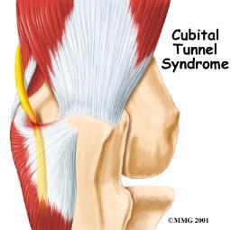 Cubital Tunnel Syndrome History 2nd most common neuropathy in UE Sensory changes 4th-5 th digits Medial elbow pain Physical Exam Elbow Flexion Test