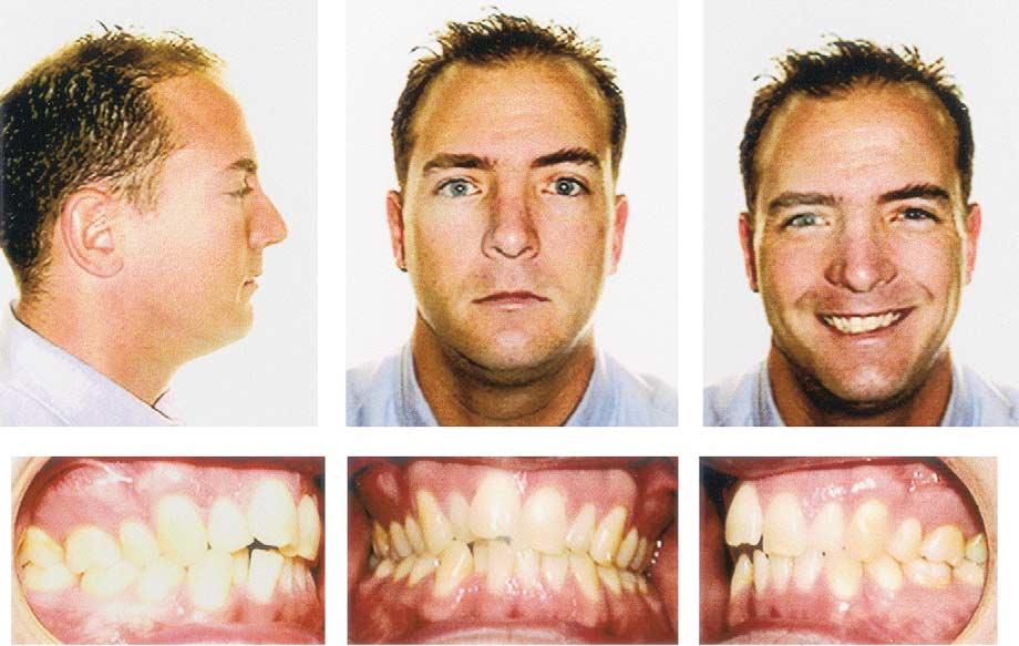 American Journal of Orthodontics and Dentofacial Orthopedics Volume 122, Number 3 Womack et al 311 Fig 1. Pretreatment facial and intraoral photographs. Fig 2. Pretreatment models.