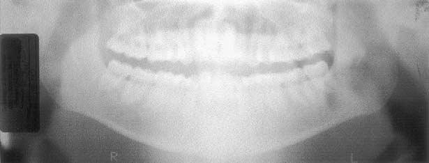 312 Womack et al American Journal of Orthodontics and Dentofacial Orthopedics September 2002 Fig 3. Pretreatment panoramic radiograph. Fig 4. Pretreatment cephalogram. TABLE.