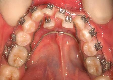 The in-standing lower left lateral incisor was not bonded initially.