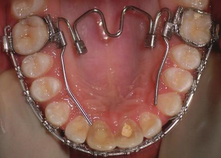 intrusion of the upper incisors.