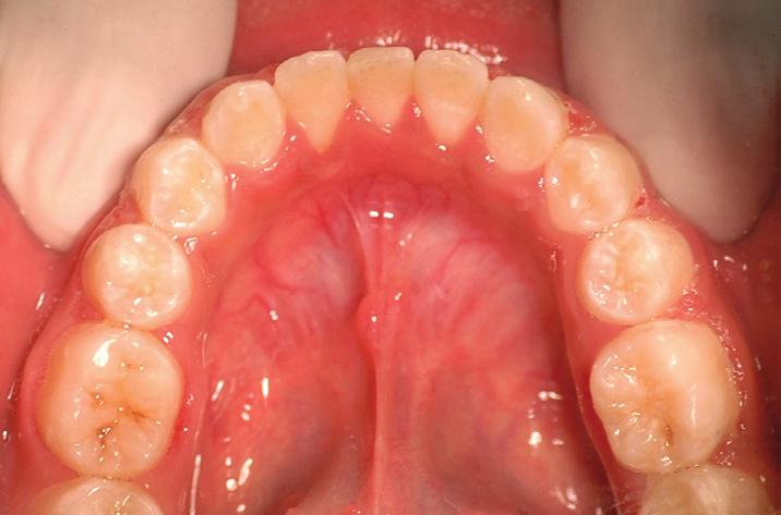 14a-14c) showed forward movement of maxillary and mandibular base along