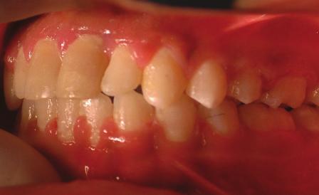 60 Figure 10a-10e: Post-treatment intra-oral Both immediate