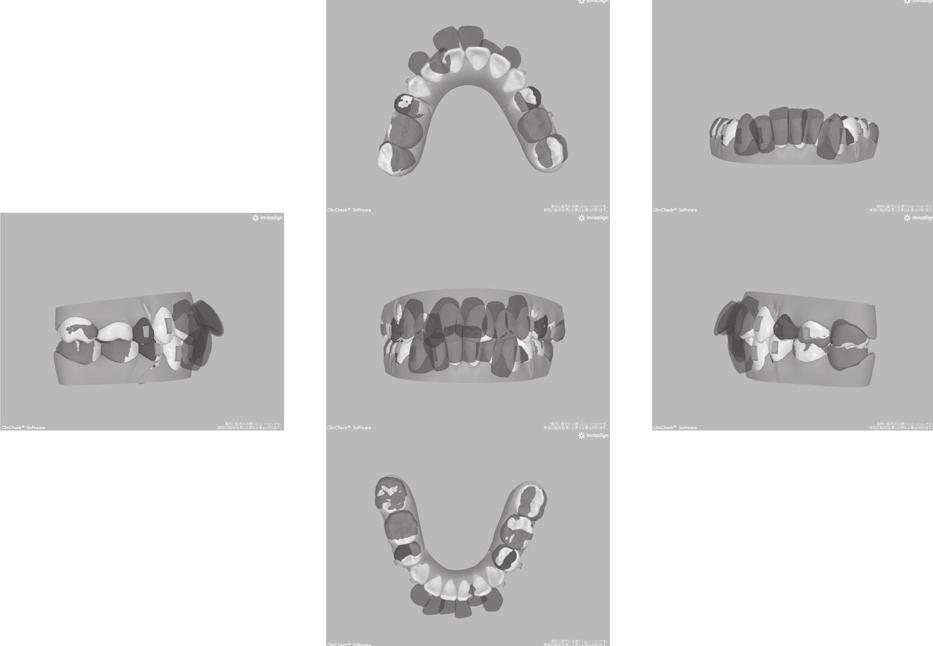 and first molars (bowing effect). Fig.