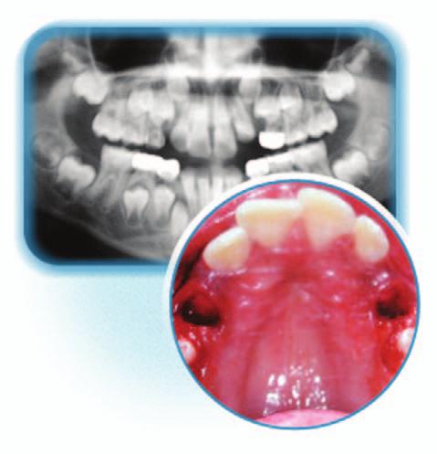 Results: The patient s treatment included serial extractions.