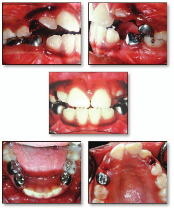 Treatment The provided treatment included serial extractions followed by a period of fixed appliance (0.