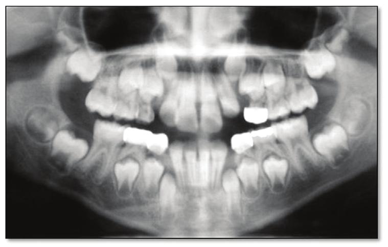 Figure 3. Pretreatment panoramic radiograph. Step 1. Extraction of the deciduous canines.
