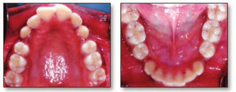 Figure 6. Eruption of maxillary permanent canines. Mandibular canines are well aligned. Figure 7. Fixed appliance slot 0.022. Banding the teeth in the maxillary and mandibular arches.