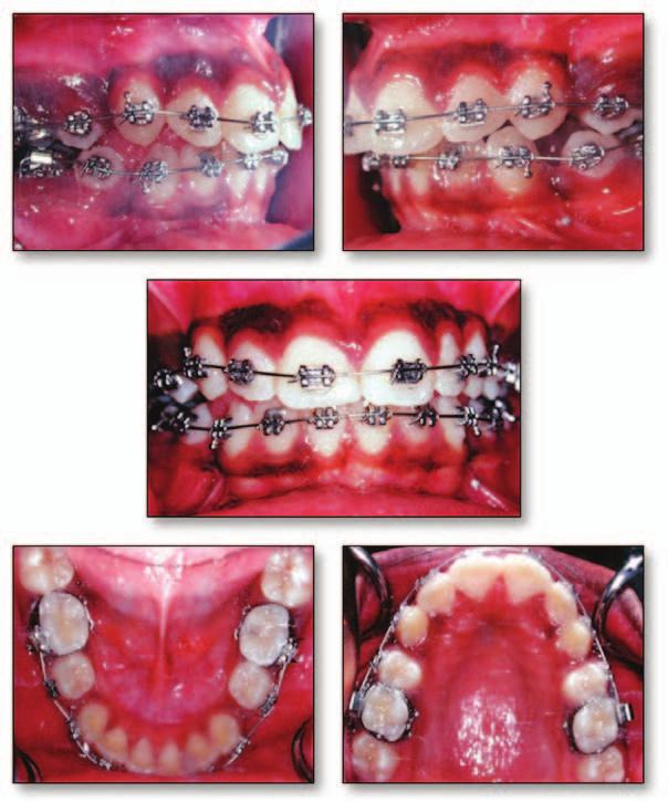 alveolar bone and the periodontal structures, and (5) it could be used for patients with disabilities who have rejected orthodontic therapy.