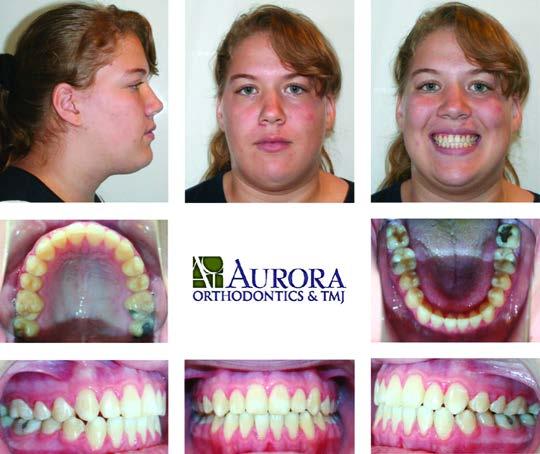 Photos at completion of treatment (note more space for the tongue due to palatal width) Additional comments are as follows: Many orthodontists and oral surgeons consider a skeletal-open-bite case
