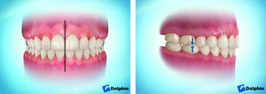 Part III Key #9 Optimal Teeth Positioning What exactly does optimal teeth positioning mean? Since a picture is worth a thousand words, the following illustration shows what we are describing.