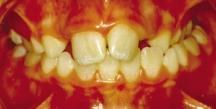 If the mandible does not center itself after expansion, then the crossbite is due to a mandibular asymmetry.