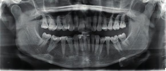Case 1: Class II and deep bite correction with the Invisalign System and weekly aligner changes.