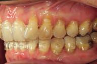 Impact of weekly aligner changes on clinical practice Long treatment periods with complex movements, such as distalization of upper