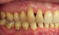 Teeth 12, 22 demonstrated good aligner fit during the later aligner numbers.