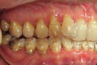 Treatment outcome Following treatment with 59 aligners over a 15-month period, the planned treatment goal of the distalization of