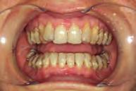 Comparison of this case with patients prescribed aligner changes every 2 weeks Distalization with the Invisalign System is highly