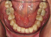 With an aligner change every 2 weeks, the overall treatment time in this case would have been 29 months, with a potential additional
