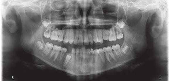 Case 2: Treating a teenage patient with deep bite, increased overbite and impacted first premolar with the Invisalign
