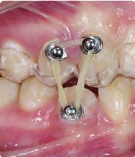the upper canines and the lower first molars Optimised attachments were located on the premolars and the