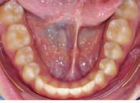 Once the occlusal third of the buccal surface was erupted, buttons were placed on the buccal aspects of the