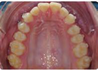 to control the intrusion movement and the lingual root torque of those teeth.
