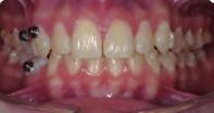 ) to facilitate the en-masse retraction of the upper incisors.