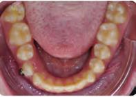 Surgical removal of follicular cyst and traction of implanted premolar After the upper premolars were